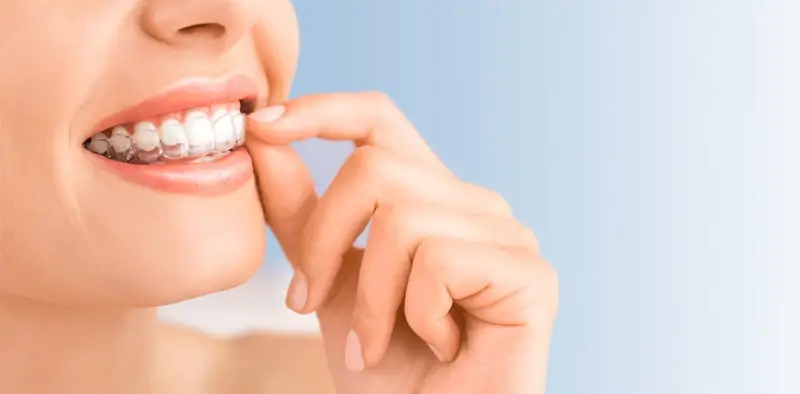 Invisible orthodontics 1.jpg